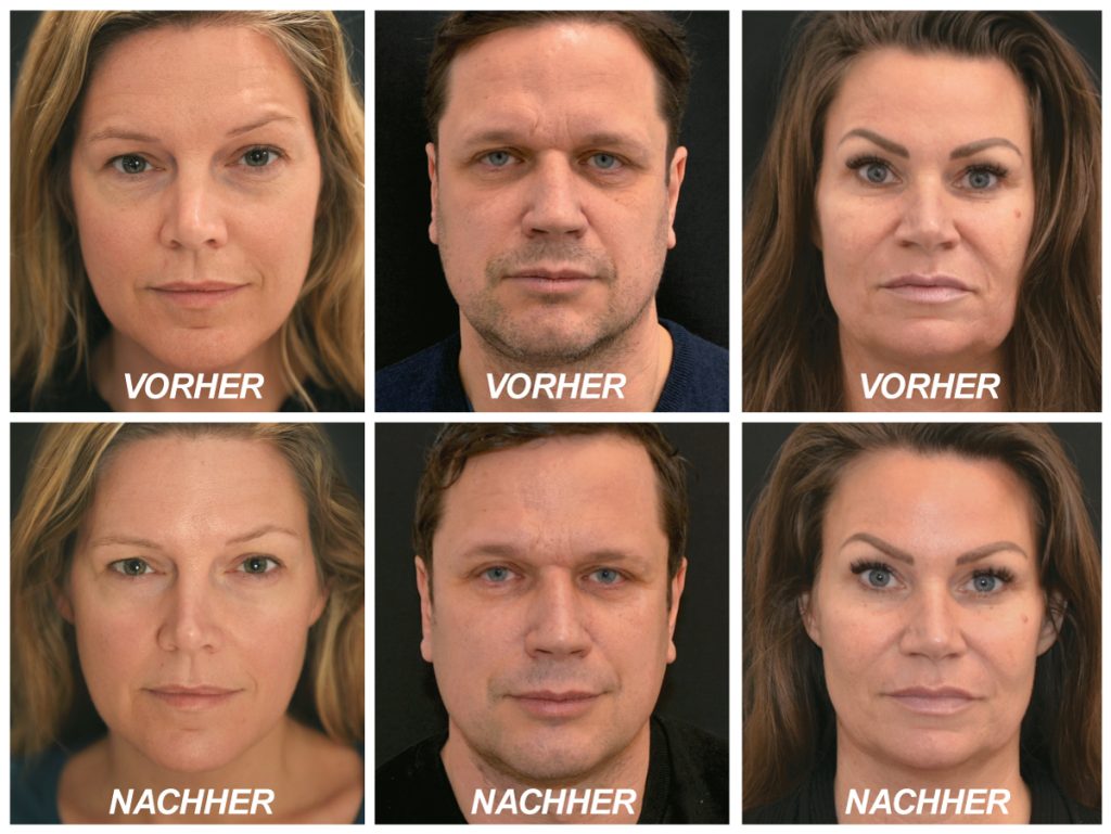 2019 06 Infuzion Ergebnisse Vorher Nachher Bilder &bull; INFUZION