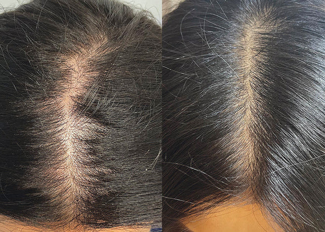 kopfhaut vorher nacher &bull; Hydrafacial Kopfhaut